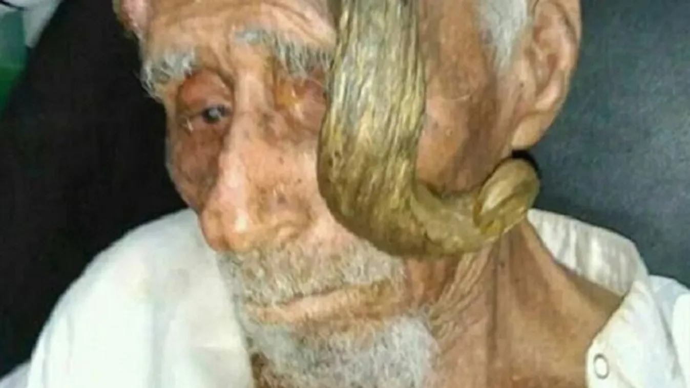 Szarvak nőttek a fején, 140 évesen meghalt a Kecskeember