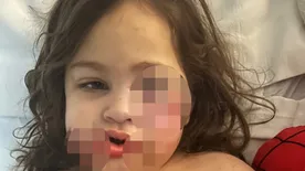 Már soha nem tud ugyanúgy mosolyogni – a család kutyája marcangolta szét a kislány arcát