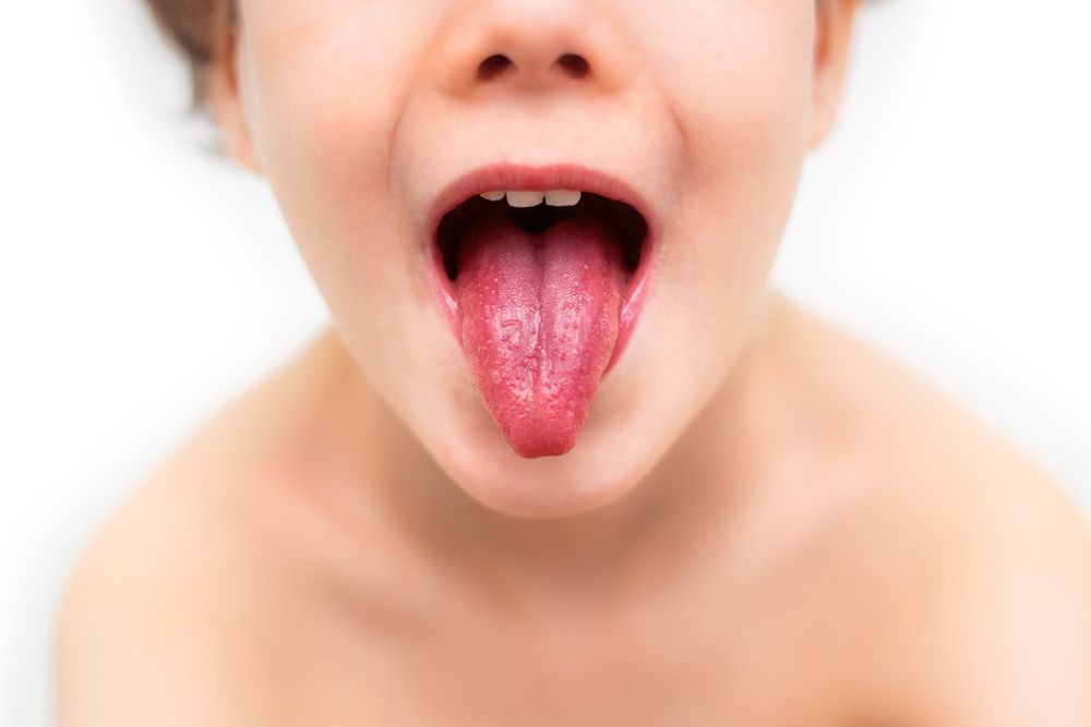 Tongue,And,Mouth,Of,A,Child,During,Scarlet,Fever