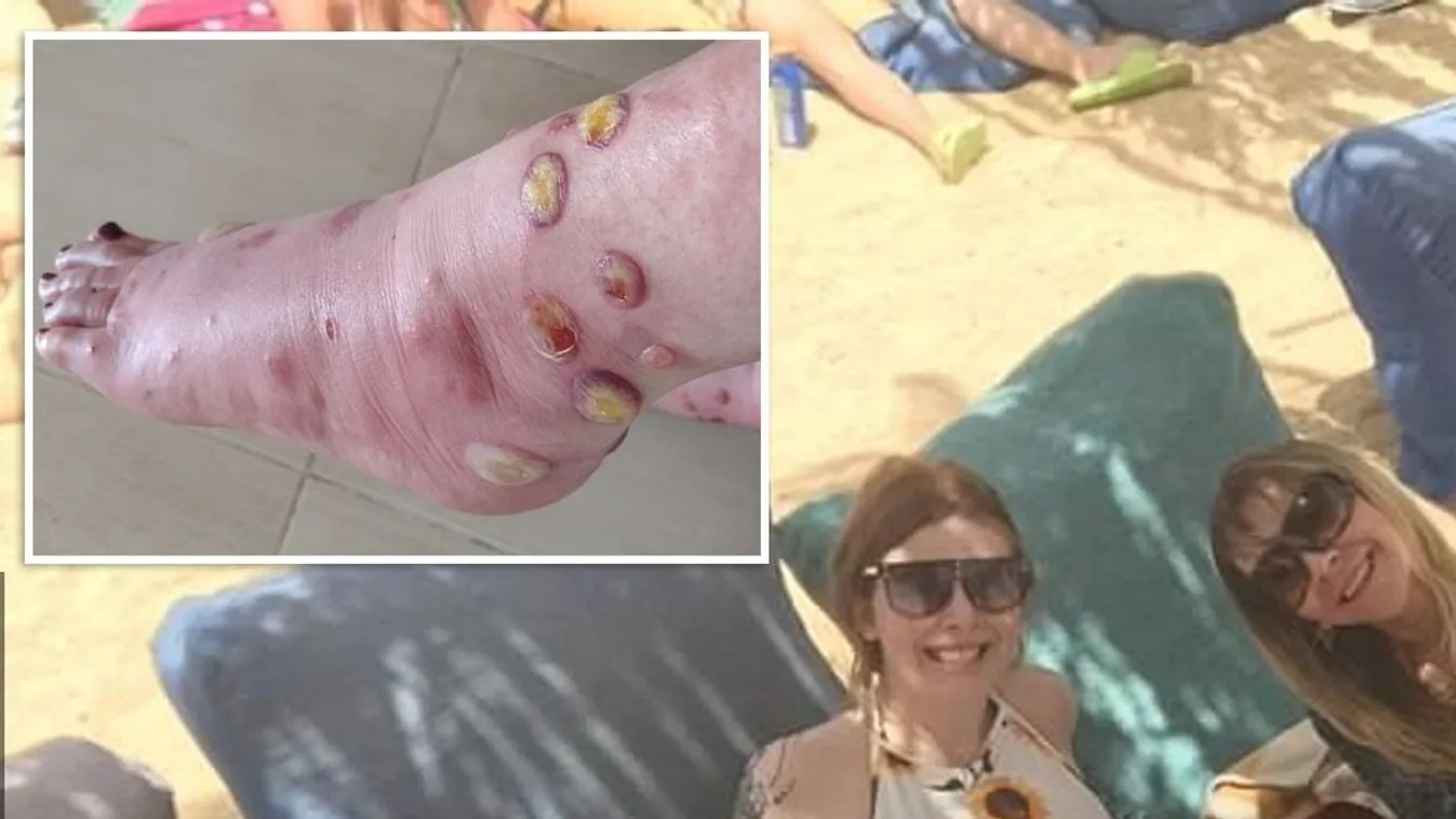 Brutális sebek lettek a szúnyogcsípésekből a nyaraláson