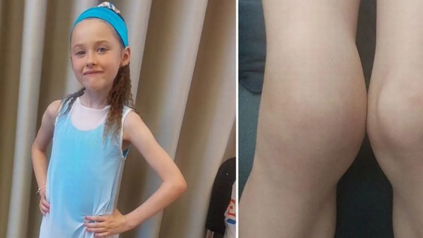 Súlyos diagnózist kapott a 6 éves kislány, miután elesett