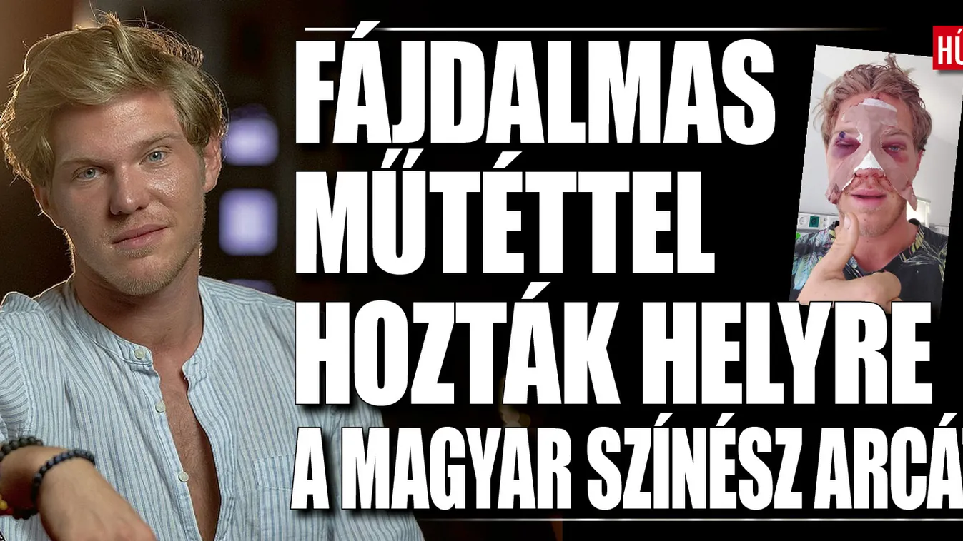 Újra műteni kellett Szaszák Zsolt orrát