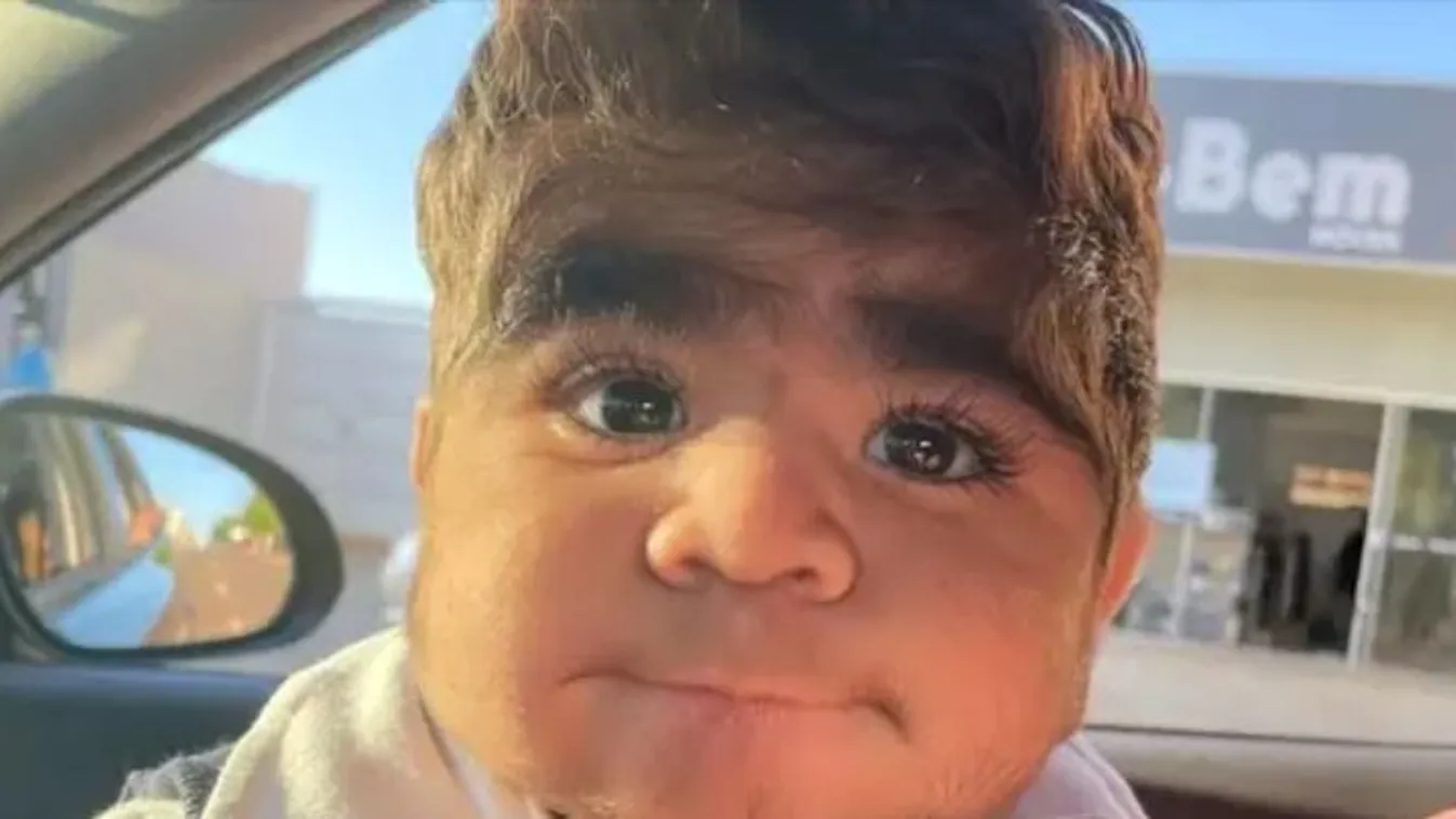 Imádják TikTokon a szőrös arcú kisfiút