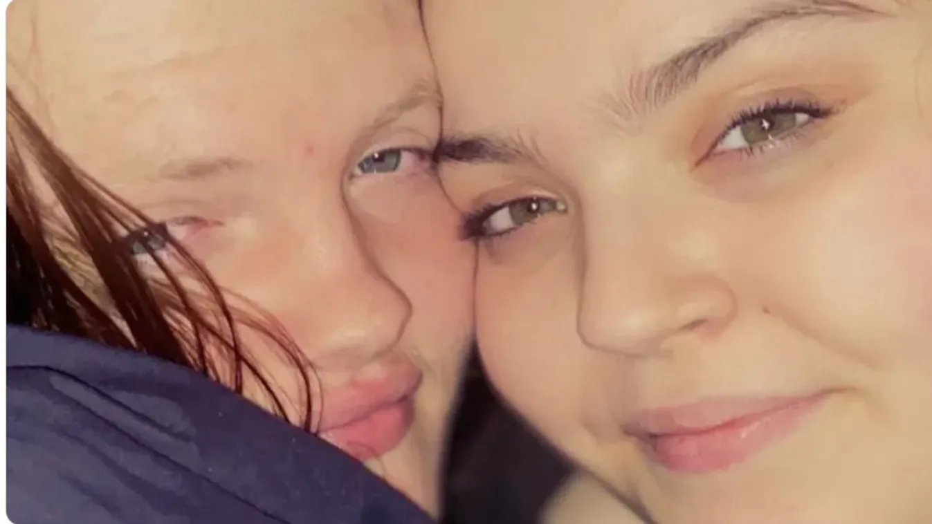 Testsúlycsökkentő műtétbe halt bele egy fiatal lány