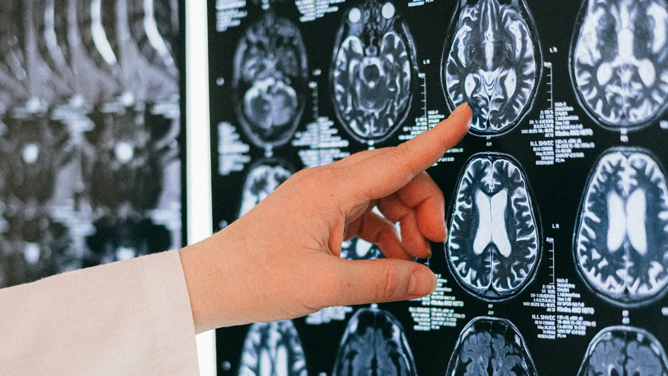 Lustasággal vádolták a 12 éves fiút, óriás agydaganata nőtt