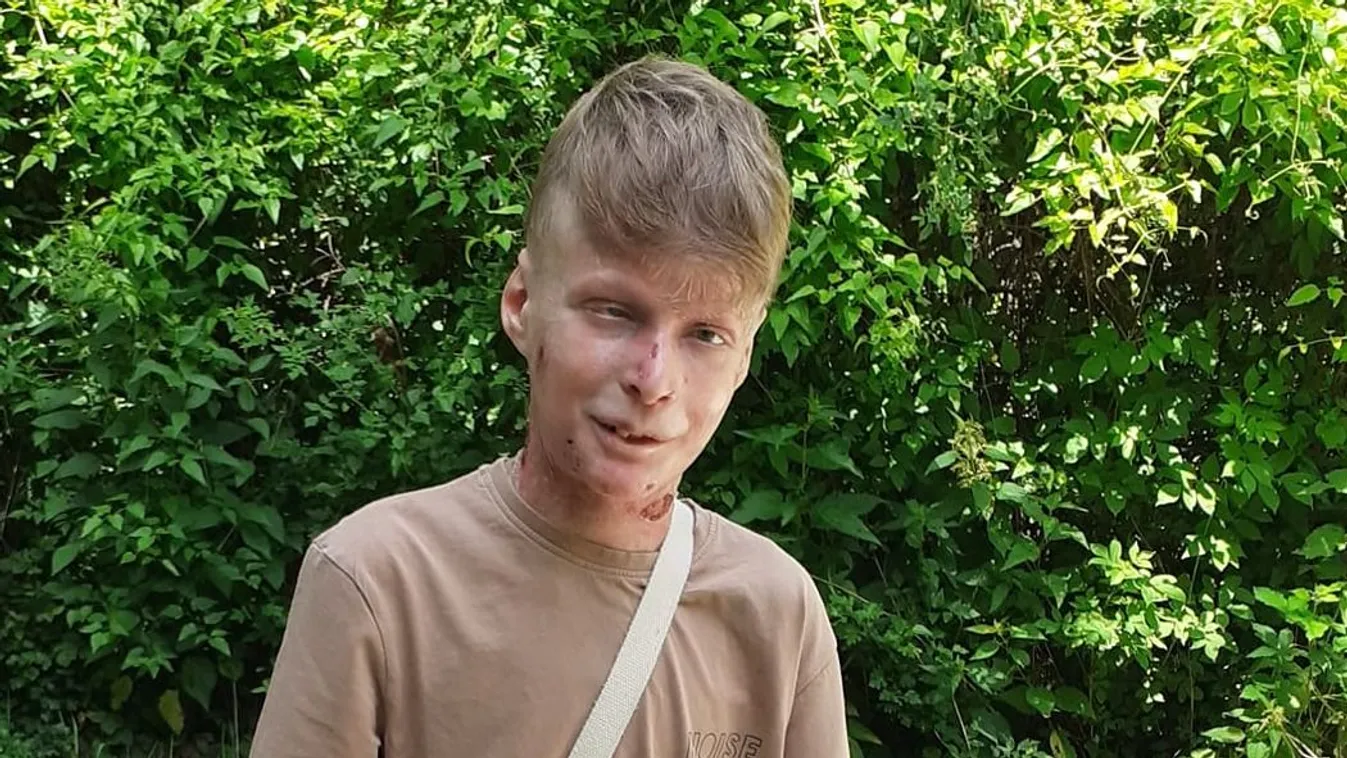 "Nem a te szégyened" - kifakadt a bőrbeteg Flórián