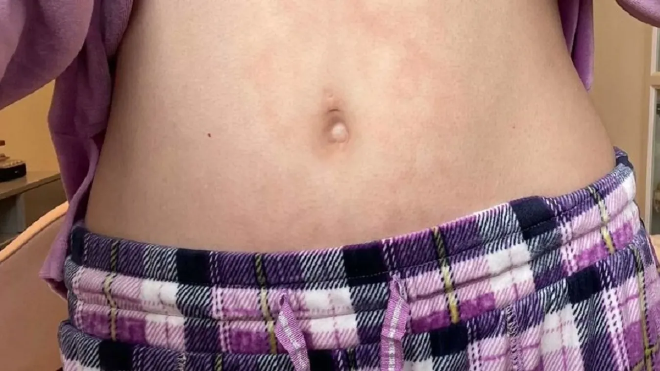 Csúnyán megsérült egy nő a fűtésen való spórolás miatt