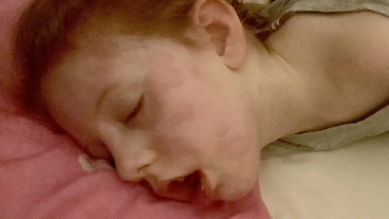 Az életéért küzdött az 5 éves Lily egy pókcsípés miatt