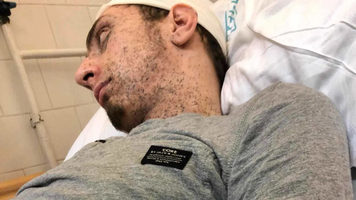 Márk testének 30 százalékát vasszilánkok borítják /