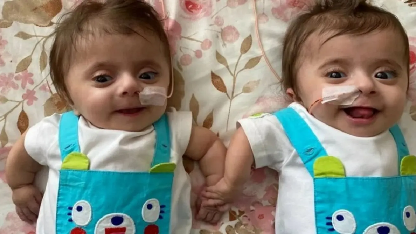 Tojáshéj törékeny csontokkal született egy ikerpár