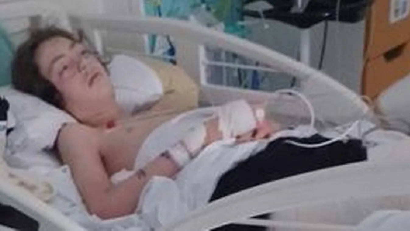 Sült krumplit akart, brutálisan megégett a 14 éves fiú