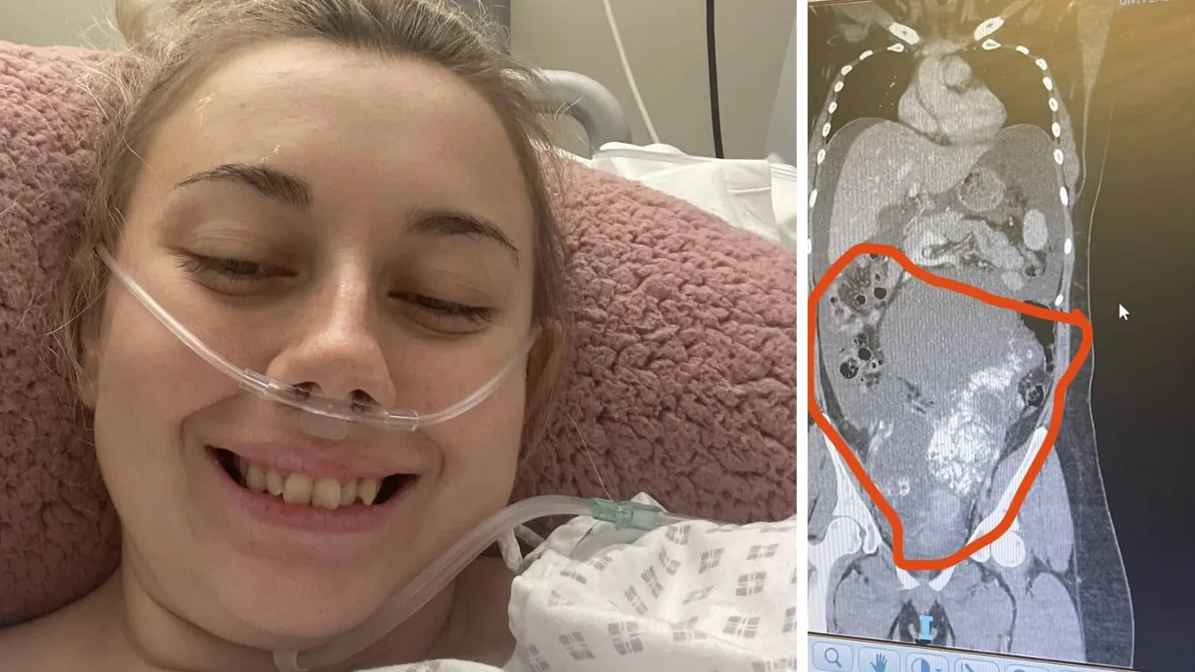 Terhesnek hitték Emmát a dokik, valójában a rák támadta meg