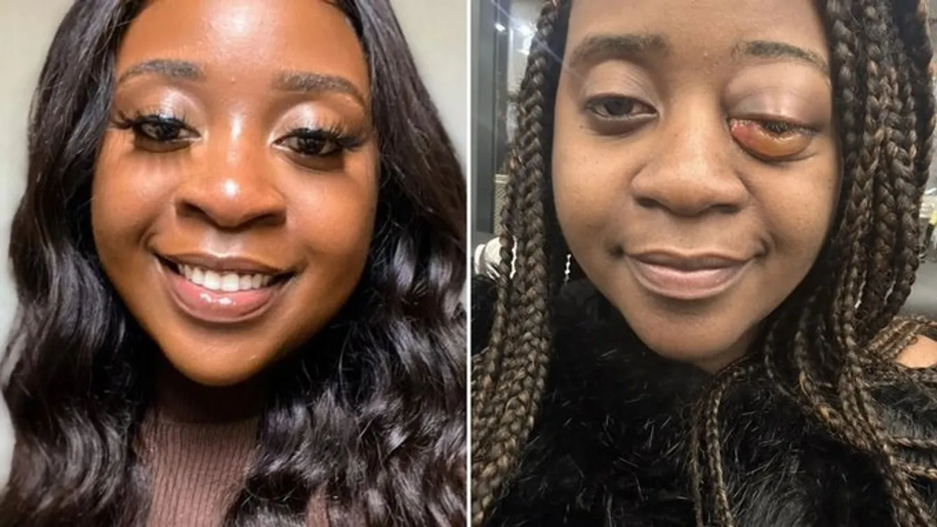 Majdnem belehalt a szemgyulladásnak hitt betegségbe a lány