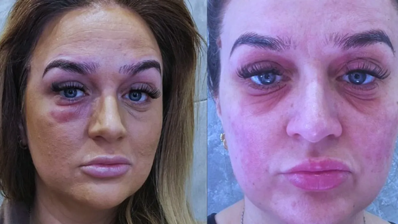 Súlyos reakciót váltott ki a nőnél a sminkje