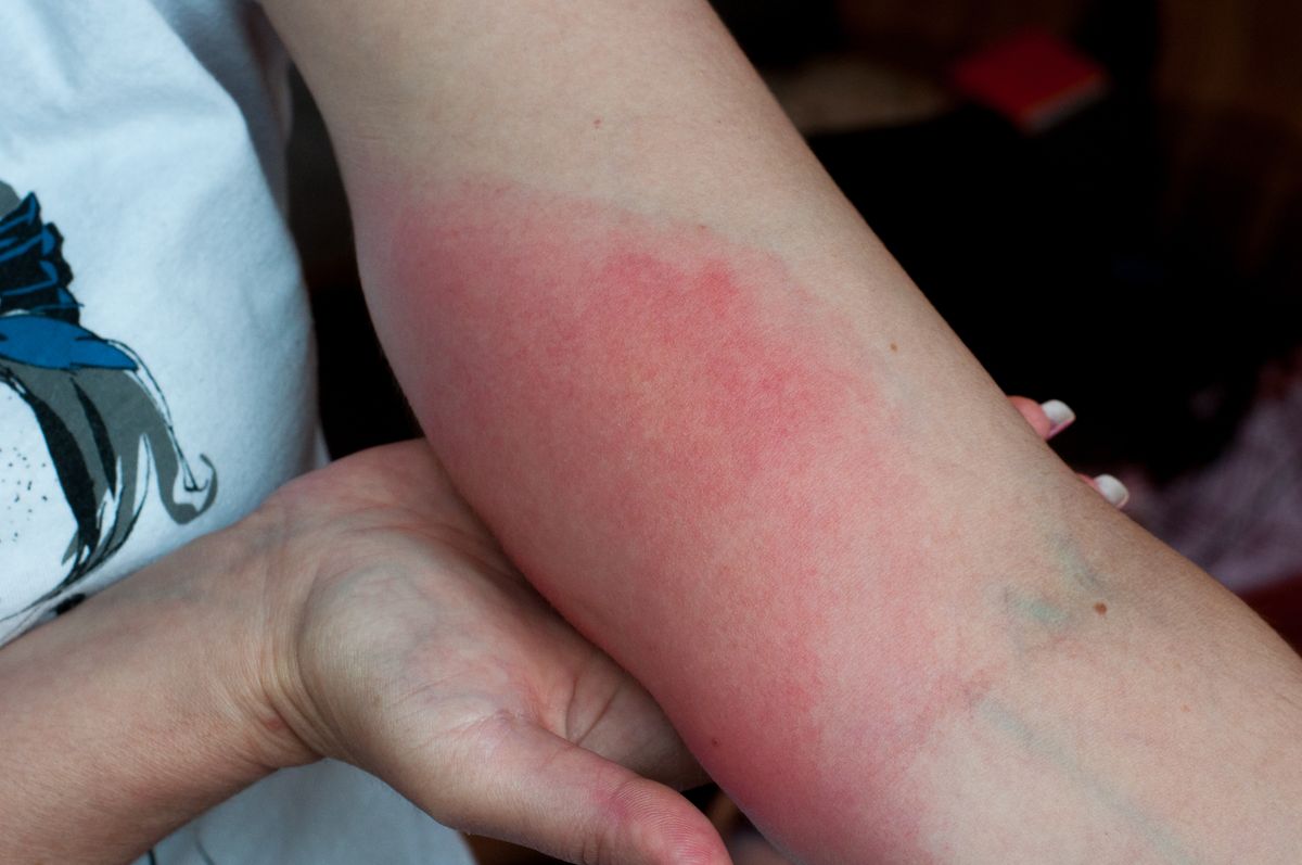 Wasp,Sting.,Red,Swollen,Arm,Closeup.,Skin,Allergy