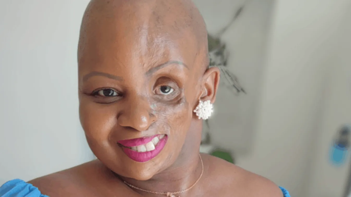 Ritka betegség torzította el a fiatal nő arcát