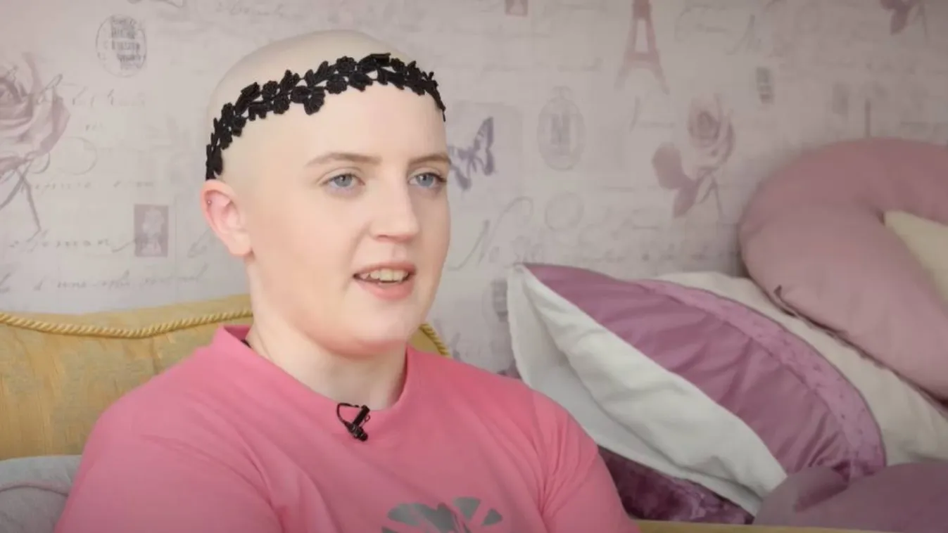 A világ legritkább allergiája: saját haja kínozza a fiatalt