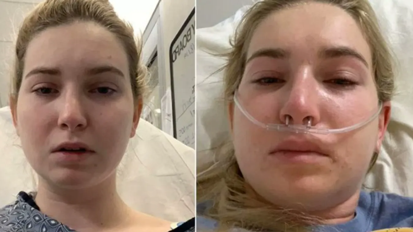 Akár egy csók is megölheti: allergiával küzd a 25 éves nő