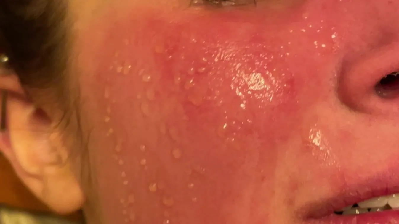 „A rejtélyes betegségtől a könnyeim olyanok, mint a sav”