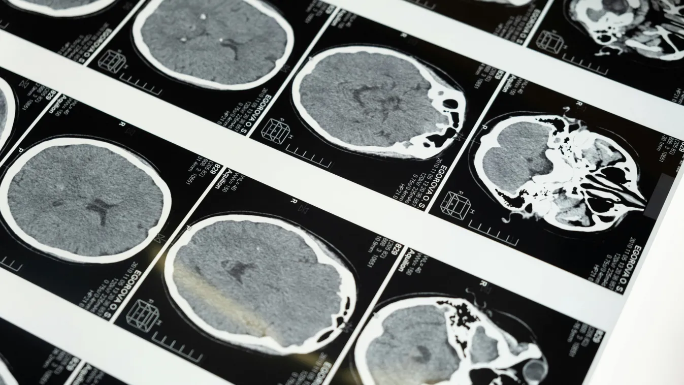 Nem hittek az orvosok a szemüknek a férfi eredményei láttán