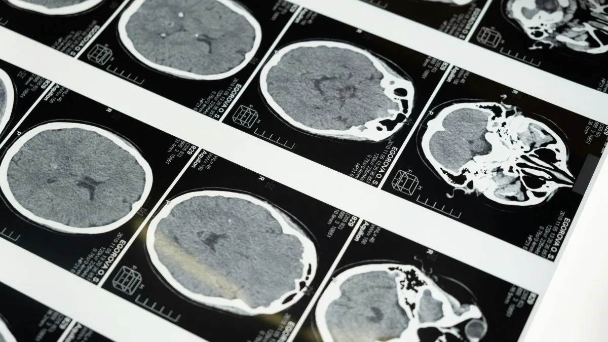 Az aggyal kapcsolatos problémák mindig nagy veszélyt rejtegetnek, hiszen rengeteg kérdés van még az orvoslás ezen területén.