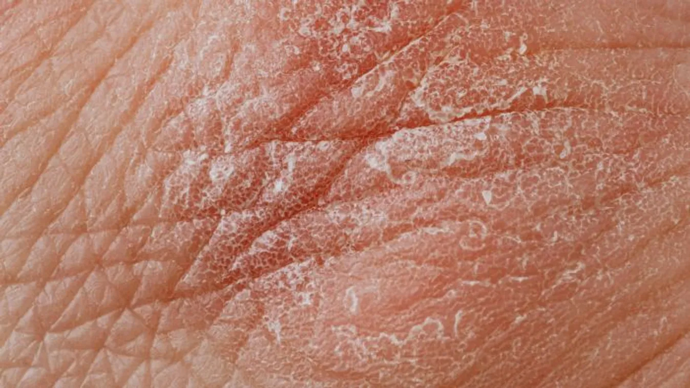 Nagyon durva, új bőrbetegséget fedeztek fel