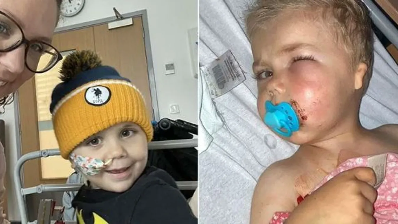 Hugo szénanáthája valójában leukémia volt