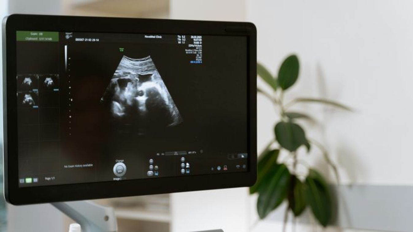 ,,A kisbabám tágra nyílt szemmel született, de mosolyogni sosem fog tudni”