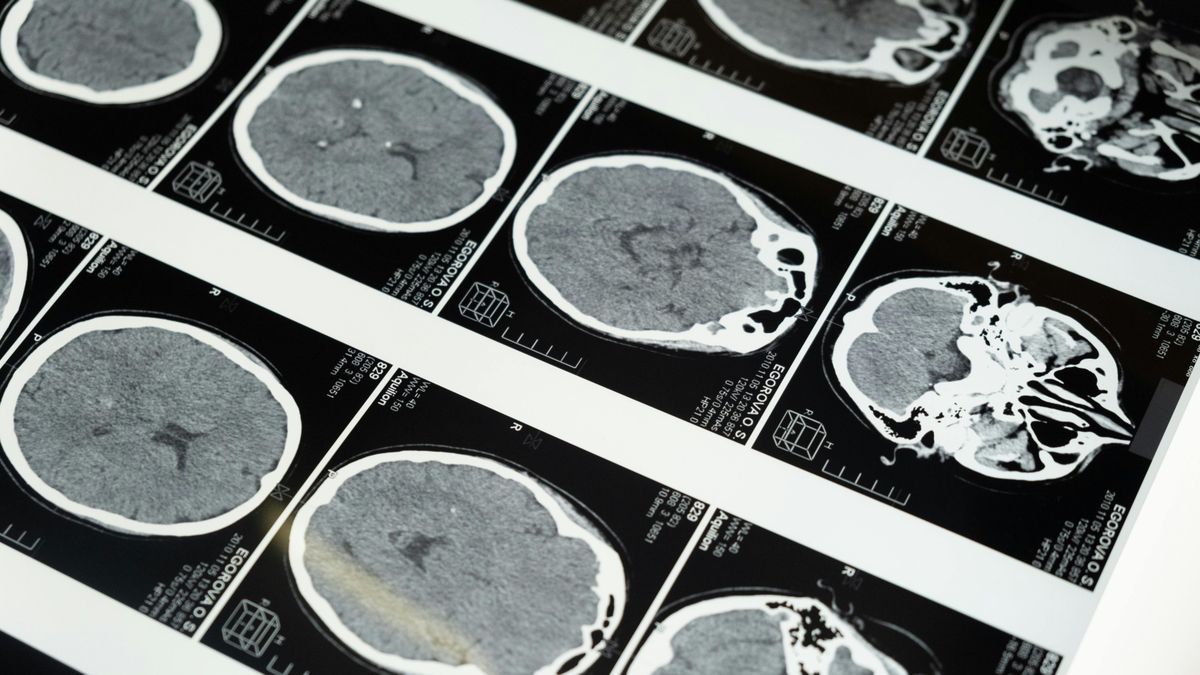 A Harvard kutatói elárulják: így csökkentsd az Alzheimer-kór kialakulásának kockázatát