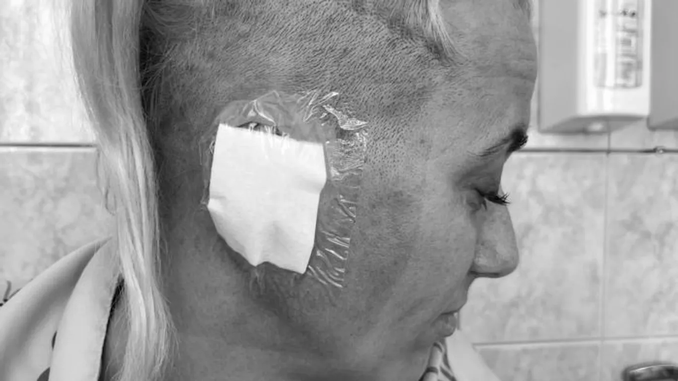 Rollerbaleset: saját állkapcsa törte át a hallójáratát