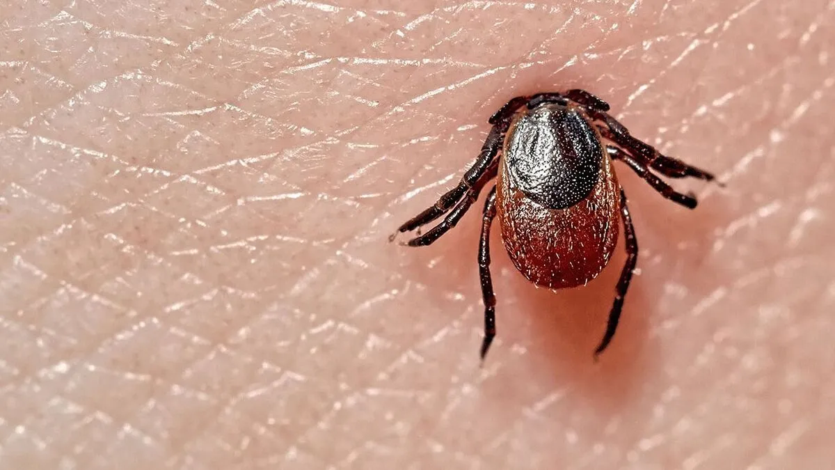 Sucking,Tick,Macro,Photo,On,Human,Skin.,Ixodes,Ricinus.,Bloated, kullancs,