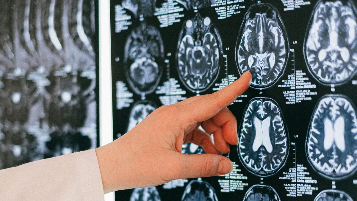 agy demencia neurológia