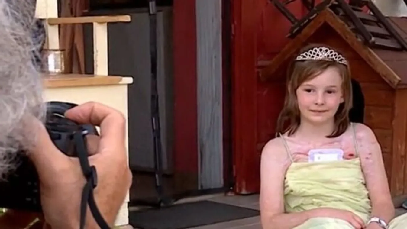 Szörnyetegnek csúfolták a megégett kislányt