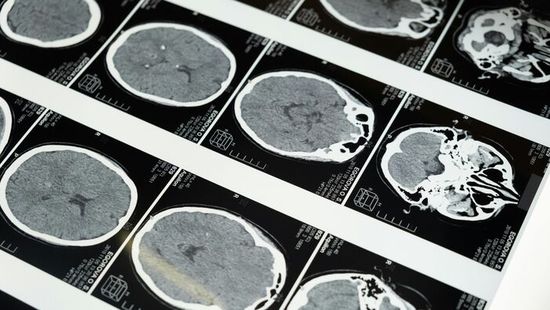 A Harvard kutatói elárulják: így csökkentsd az Alzheimer-kór kialakulásának kockázatát