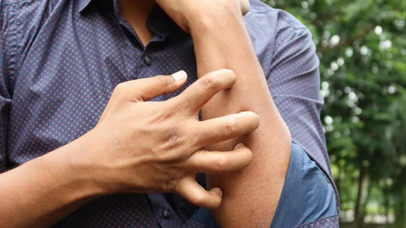 Brutális rovarcsípésekkel vannak tele a sürgősségi osztályok