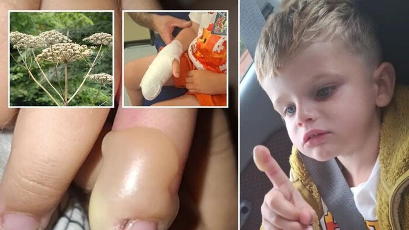 Szilva méretű fájdalmas hólyag lett a 3 éves fiú ujja
