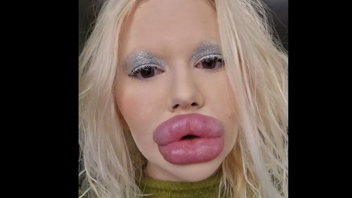 Brutálisan néz ki a világ legnagyobb szájú nője: ilyen volt a plasztika előtt