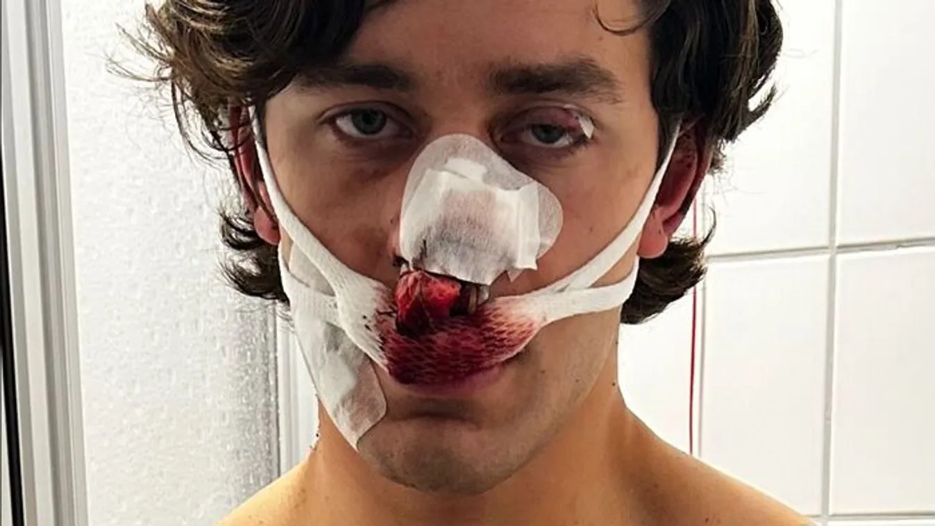 Brutális támadás áldozata lett a hős turista