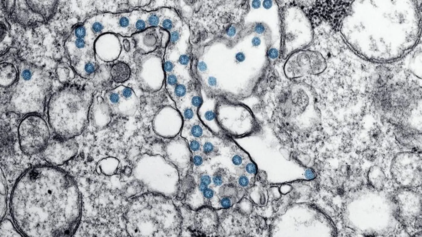 Agyevő amőba ölt meg egy férfit