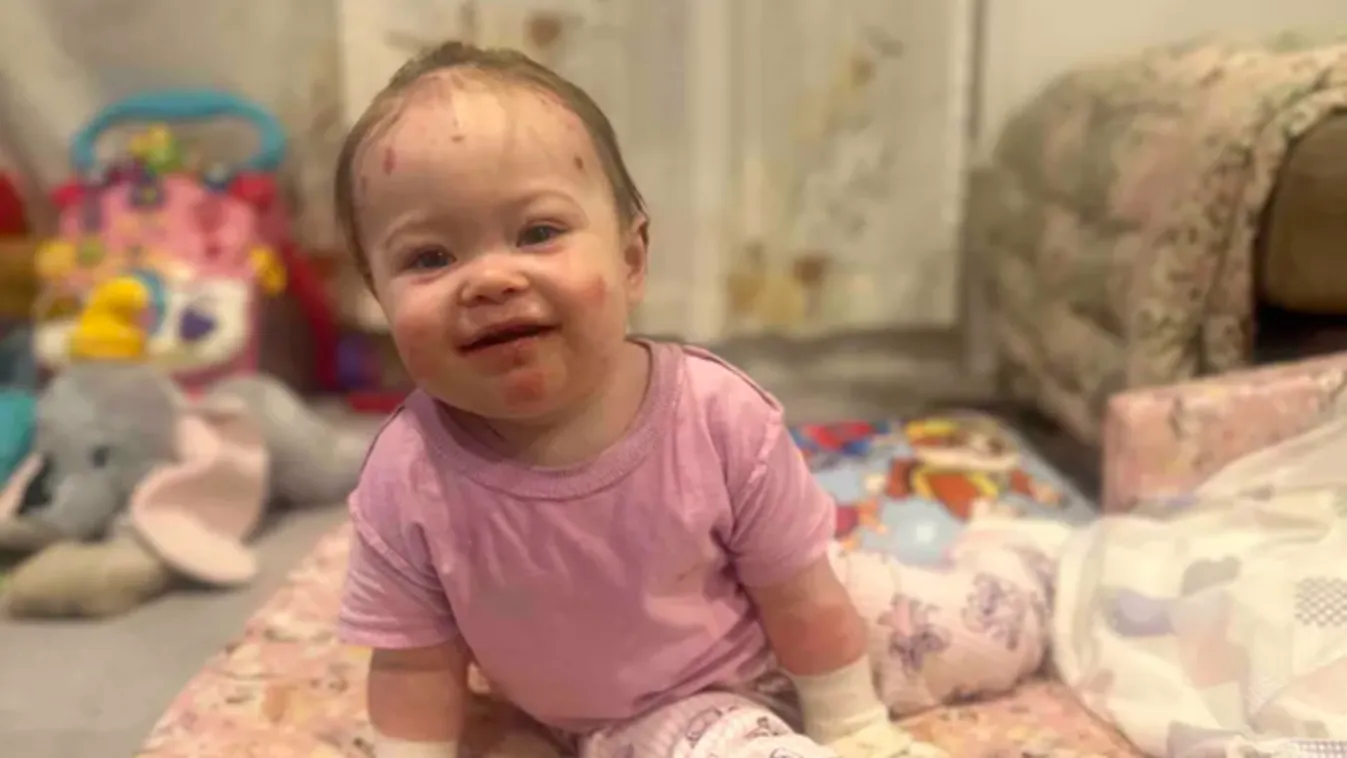 Pillangóbőrrel született egy kislány