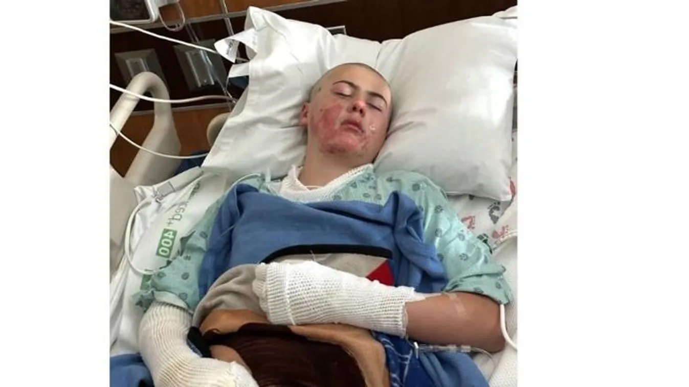 Lángra kapott a teste a fiúnak egy TikTok trend miatt