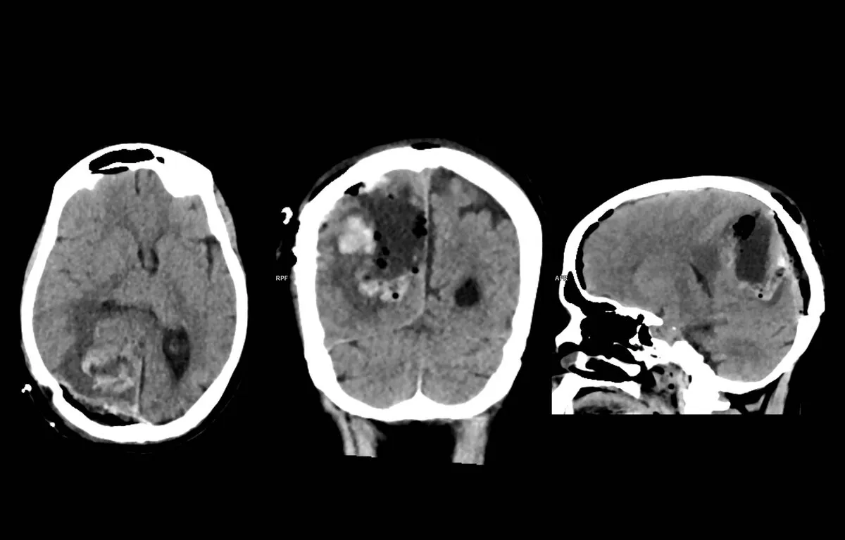 Post-operative brain, CT scans