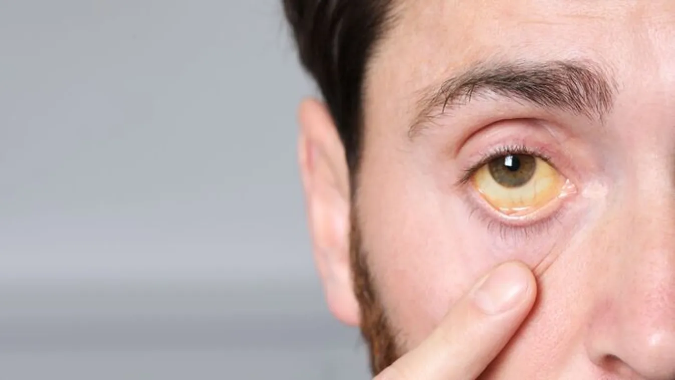 Sárgaságjárvány a szomszédban? Riasztó, ami ott zajlik