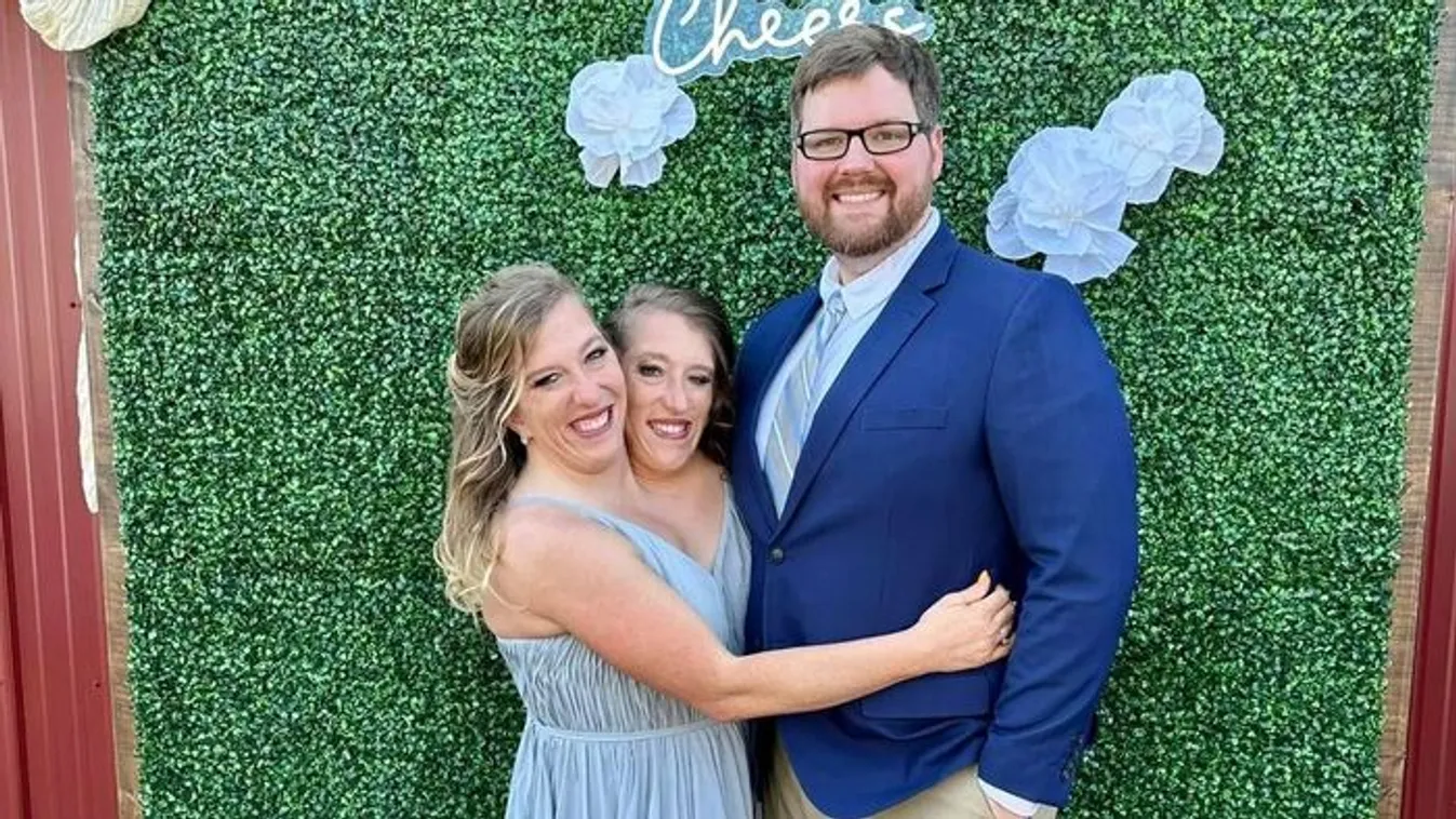 Hogyan működik a sziámi ikrek teste? Most te is láthatod!