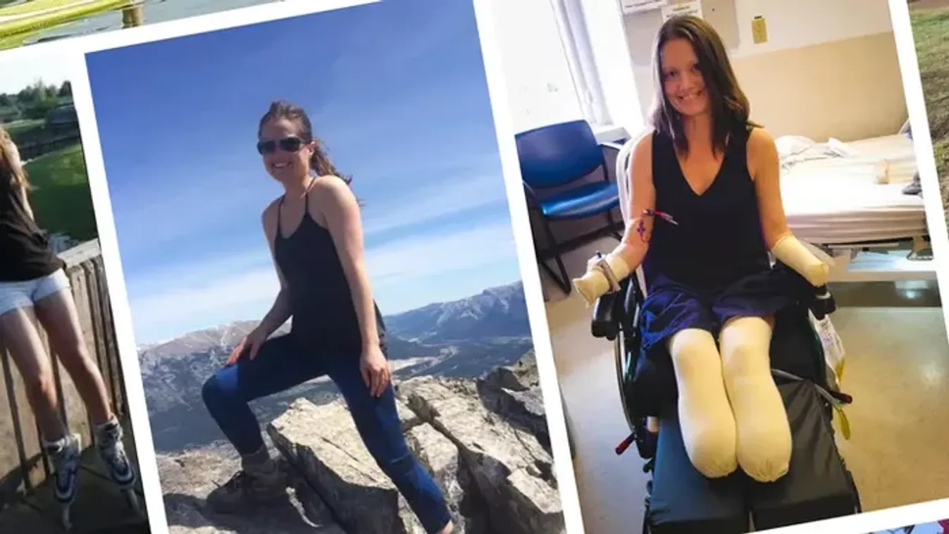 Négyszeres amputáció: mindegyik végtagját elvesztette egy nő