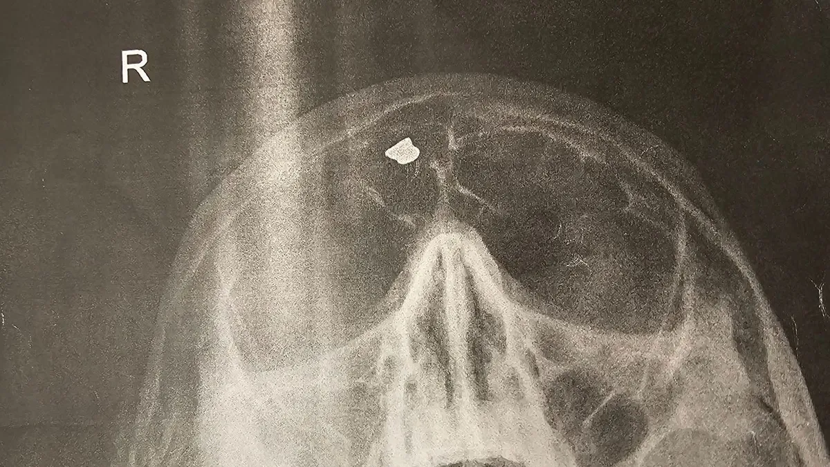 Negyven évig nem beszélt a csínytevésről a hevesi férfi: koponyaröntgenből derült ki az igazság