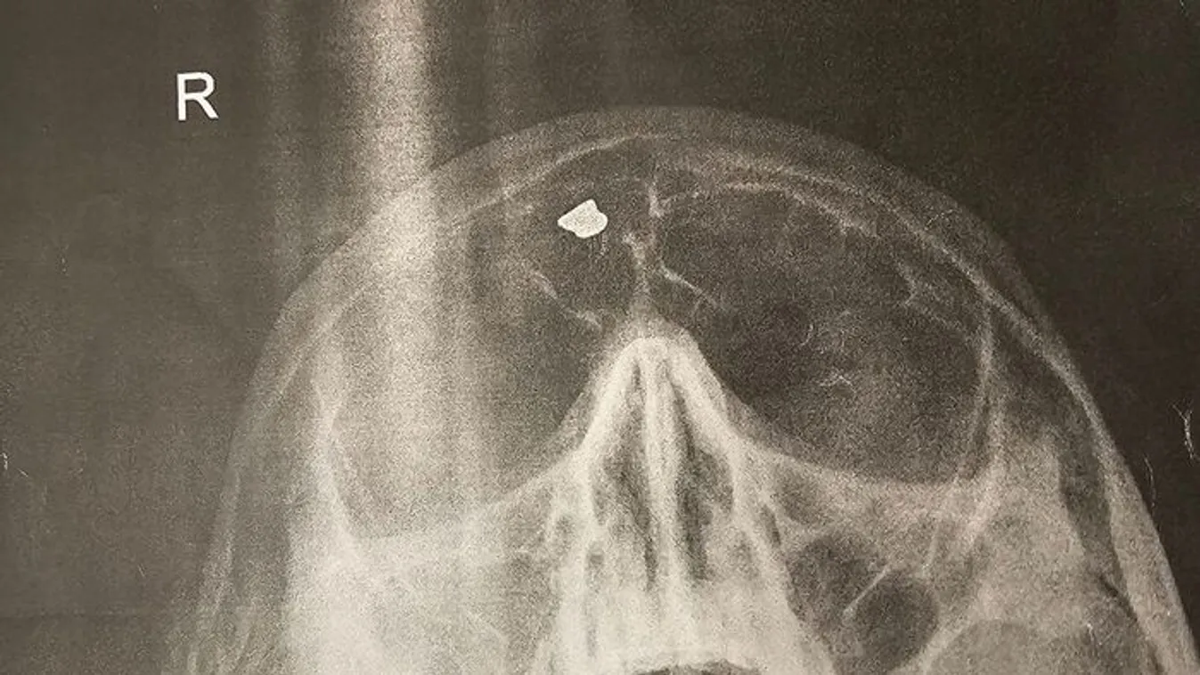 Hihetlen, mit találtak egy magyar férfi fejében - fotó