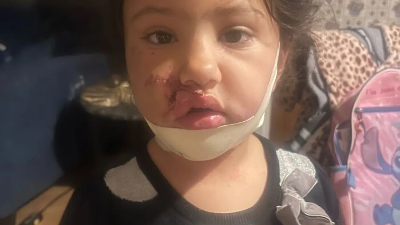 4 éves kislány arcát marcangolta egy megvadult pitbull
