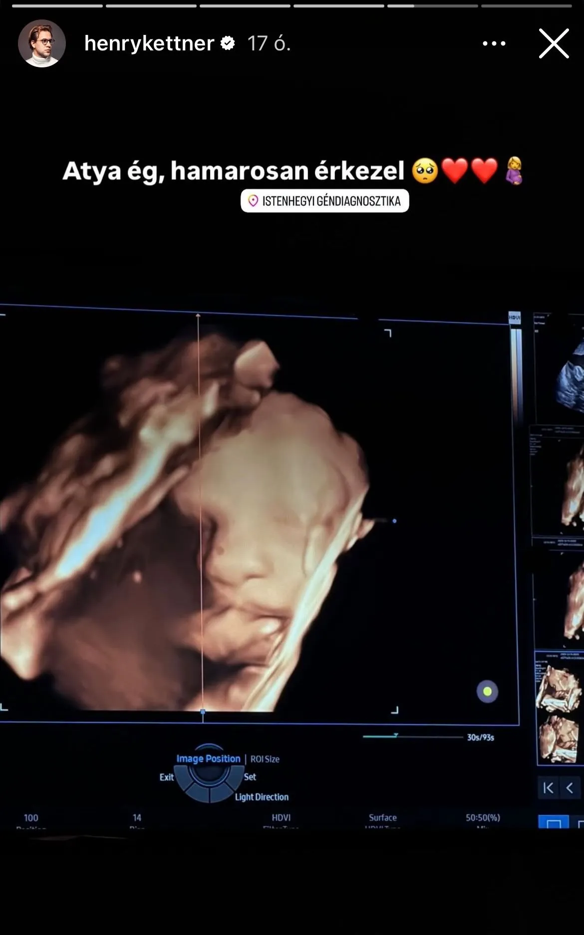 Henry Kettner babája