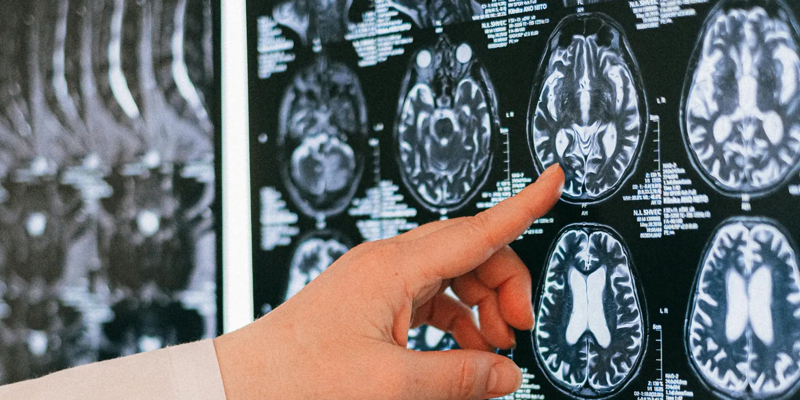 Refluxra gyanakodtak, de agydaganata volt